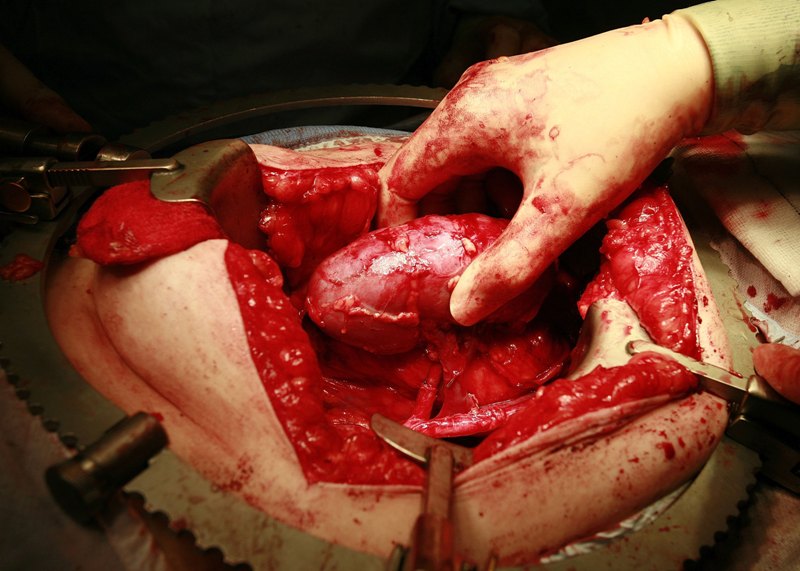 presaditev_transplantacija ledvice.jpg